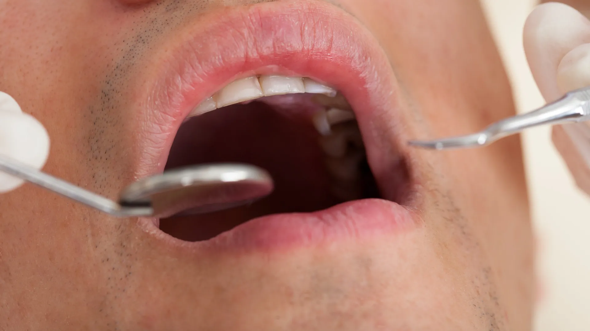 32% dos brasileiros não foram ao dentista no último ano