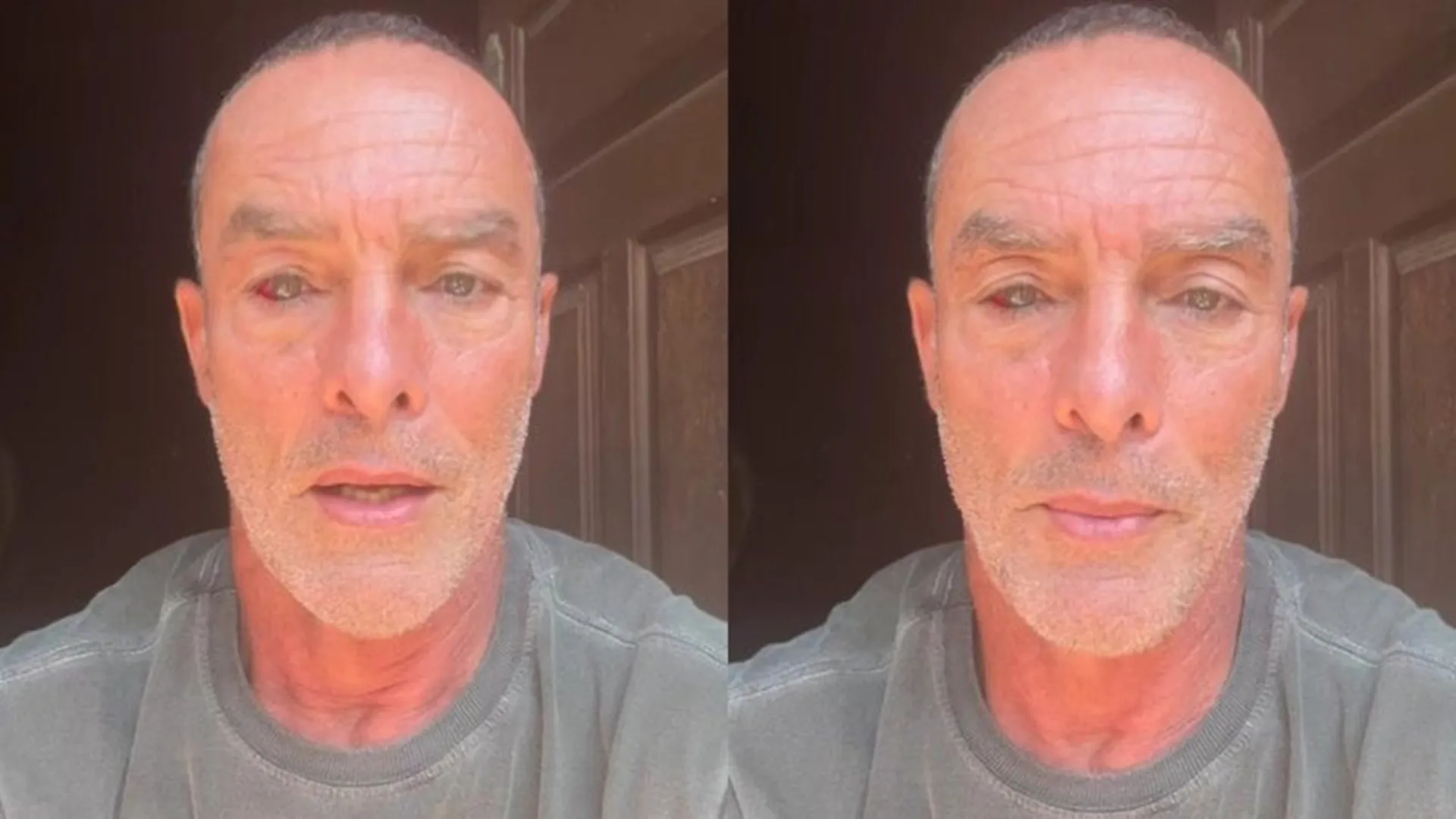 Derrame ocular como o de Paulo Zulu é perigoso?