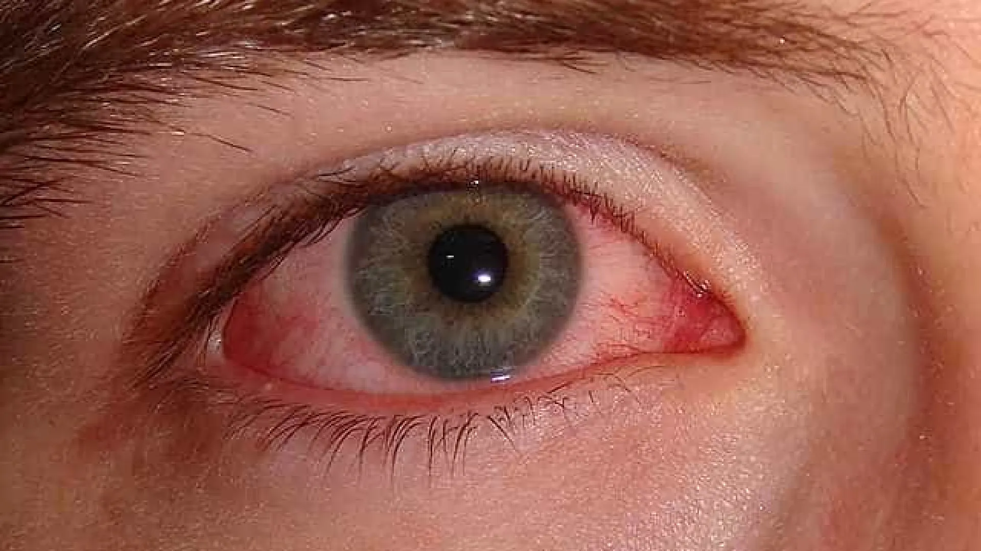 Gripe e resfriado aumentam casos de conjuntivite
