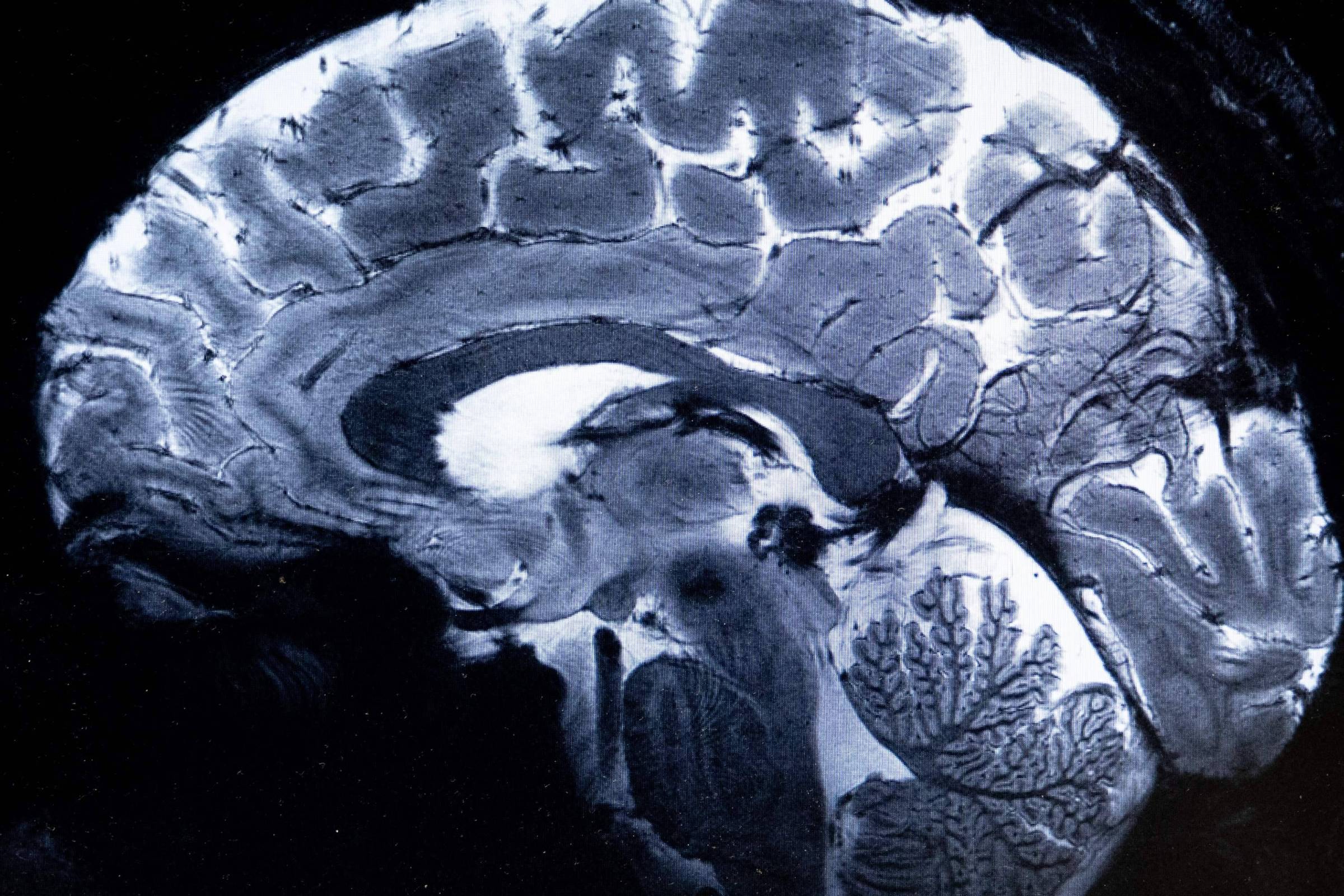 A imagem mostra uma seção transversal de um cérebro humano, destacando as dobras e sulcos da superfície cerebral. A imagem é em tons de preto e branco, com um contraste que revela a estrutura interna do cérebro, incluindo áreas que se assemelham a padrões orgânicos ou vegetais.