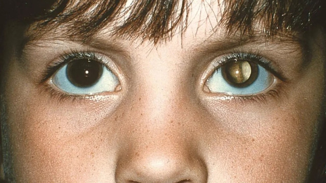 Cuidados na infância: 'olhos brancos' após tirar foto pode indicar tumor