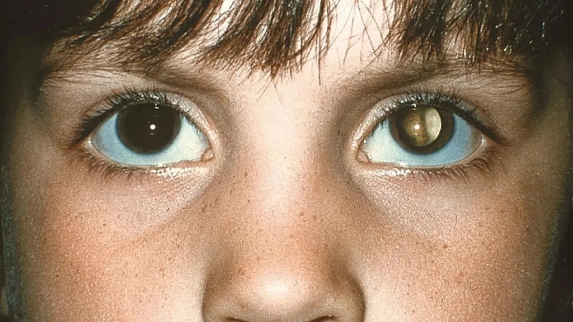 Cuidados na infância: 'olhos brancos' após tirar foto pode indicar tumor