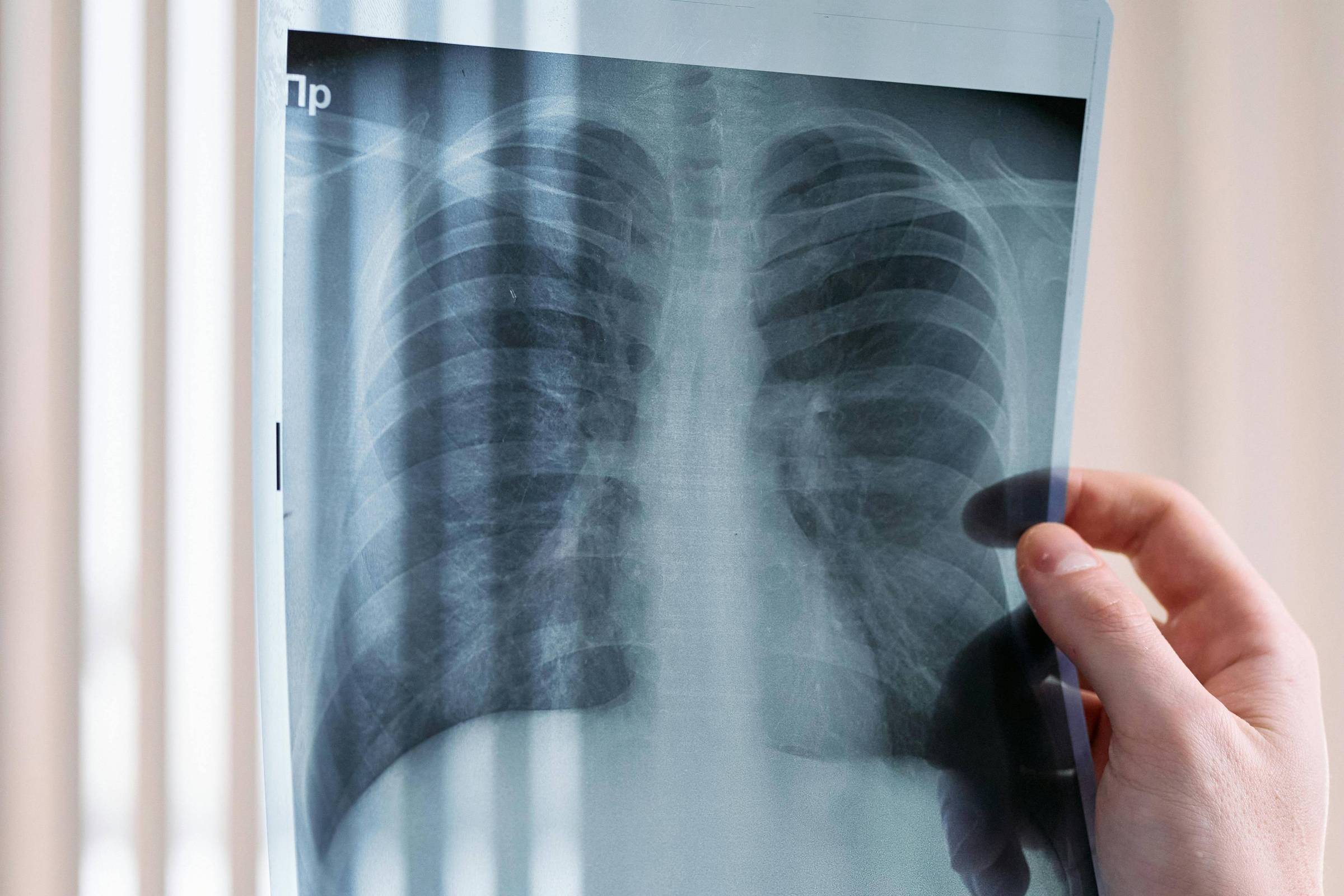 A imagem mostra uma radiografia de tórax sendo segurada por uma mão. A radiografia exibe os pulmões e a estrutura torácica, com detalhes visíveis das costelas e do coração. Ao fundo, há uma janela com persianas, criando um efeito de luz suave.