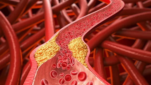 Colesterol alto avança de forma silenciosa e pode levar a infarto e AVC